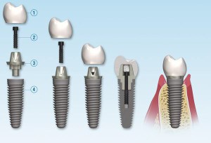 Implants 101