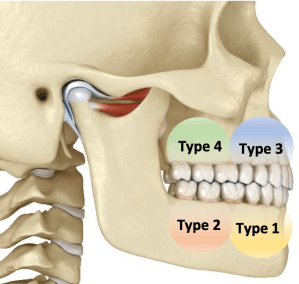 Jaw